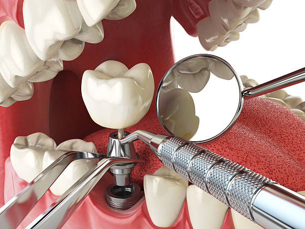 Best Emergency Wisdom Tooth Extraction in North Augusta, SC